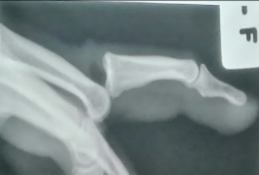 <p>Seen in Murphy’s sign</p><p>Can occur anteriorly or posteriorly</p><p>Can rupture the collateral ligaments surrounding the joints</p><p>Joints must be repositioned in extended position</p><ul><li><p>Collateral ligaments are loose in extended position & taut in flexed position</p></li></ul><p></p>