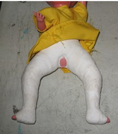 <p><span>for congenital hip dislocation</span></p>