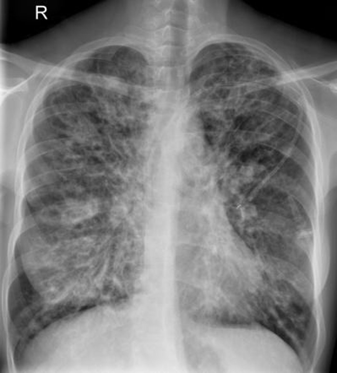 <p>-hereditary; causes excessive mucus to clog the bronchioles</p><p>-x-ray may show hyperinflated (large) lungs and lots of radiodensity</p>