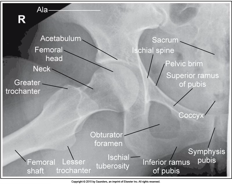 <p>AP frog leg hip (modified cleaves)</p>