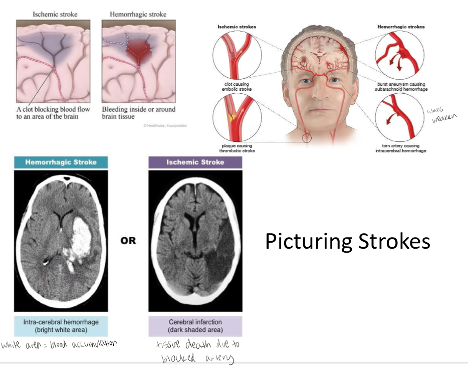 <p>A stroke occurs when the blood supply to part of your brain is interrupted or severely reduced, depriving brain tissue of oxygen and nutrients. Within minutes, brain cells begin to die. Two major categories: Ischemic stroke and Hemorrhagic stroke</p>