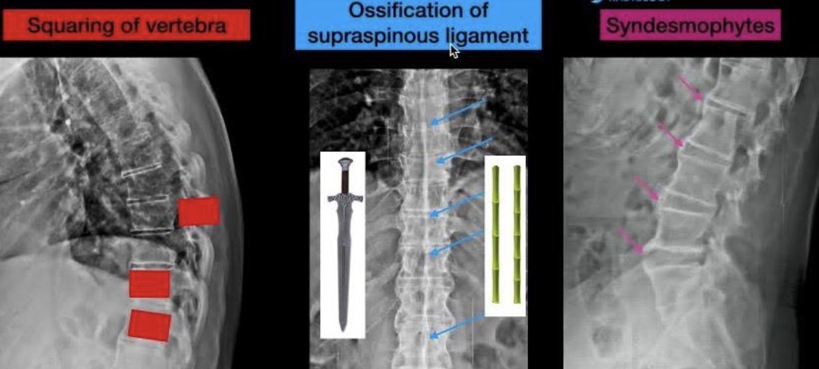 <ul><li><p>Fusion of joints in spine</p></li><li><p>First manifests in Sacroiliac joints:</p></li><li><p>Widening or fusion of SIJ’s</p></li><li><p>Vertebral body squaring, shiny corners of squares</p></li><li><p>Syndesmophytes visible - Bamboo spine</p></li><li><p>Ossification of interspinous ligaments - Dagger spine</p></li></ul><p></p>