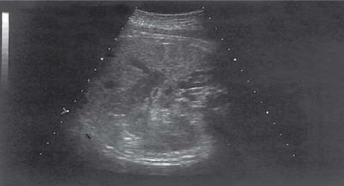 <p>Normal fetal muscles appear very low gray on ultrasound; some muscles may appear anechoic especially in abdominal wall, where they can mimic appearance of ascites</p>