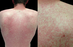 <p>rash or hives (flat red area covered with small raised bumps)</p>