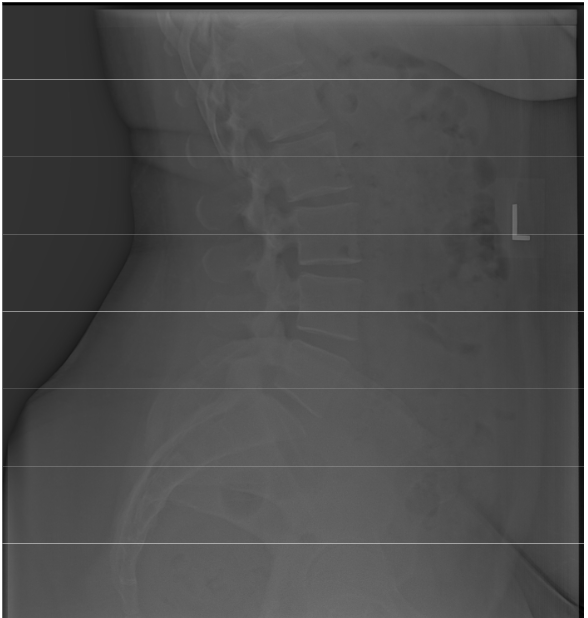 <p>Is this film of diagnostic quality (Lateral Lumbar)</p>