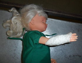 <p><span>fracture of radius and ulna with callus formation</span></p>