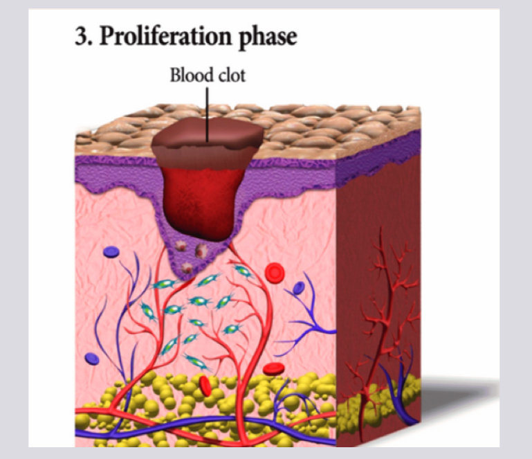 <ol><li><p>Granulation tissue is forming and replaces damaged tissue</p></li><li><p>Rebuilding via growth of blood vessels and the migration of fibroblasts which produce collagen</p></li><li><p>Macrophages are still cleaning up debris</p></li><li><p>The wound is typically pink at this point </p></li></ol><p></p>