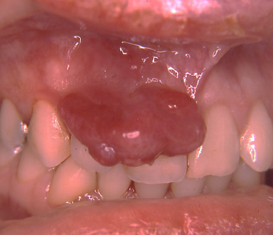 <ul><li><p>a common non-neoplastic proliferation of granulation tissue</p></li><li><p>a misnomer (not pyogenic, not granuloma)</p></li><li><p>response to local irritation or trauma </p></li><li><p>usually ulcerated</p></li><li><p>gingiva is the most common site</p></li><li><p>common during pregnancy </p></li><li><p>easily bleeds </p></li></ul><p></p>