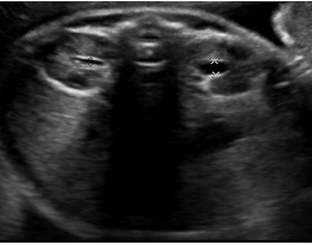 <p>measurement of renal pelvic diameter </p><ul><li><p>if RPD > 5mm at 18-23 weeks </p></li><li><p>if RPD > 7mm in 3rd trimester</p></li></ul><p></p>