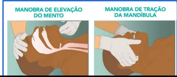 <p>Manobra de Chin Lift: elevação do queixo;</p><p>Manobra de Jaw Thrust: tração da mandíbula. </p>