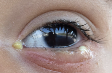 <p>Infection of the <u>conjunctiva</u></p><ul><li><p>Transmission: Eye secretions</p></li><li><p>Diagnosis: Purulent discharge</p></li><li><p>Prevention: Hygiene</p></li><li><p>Treatment: Antibiotic eye drops</p></li><li><p>Epidemiology: Very transmissible</p></li></ul><p></p>