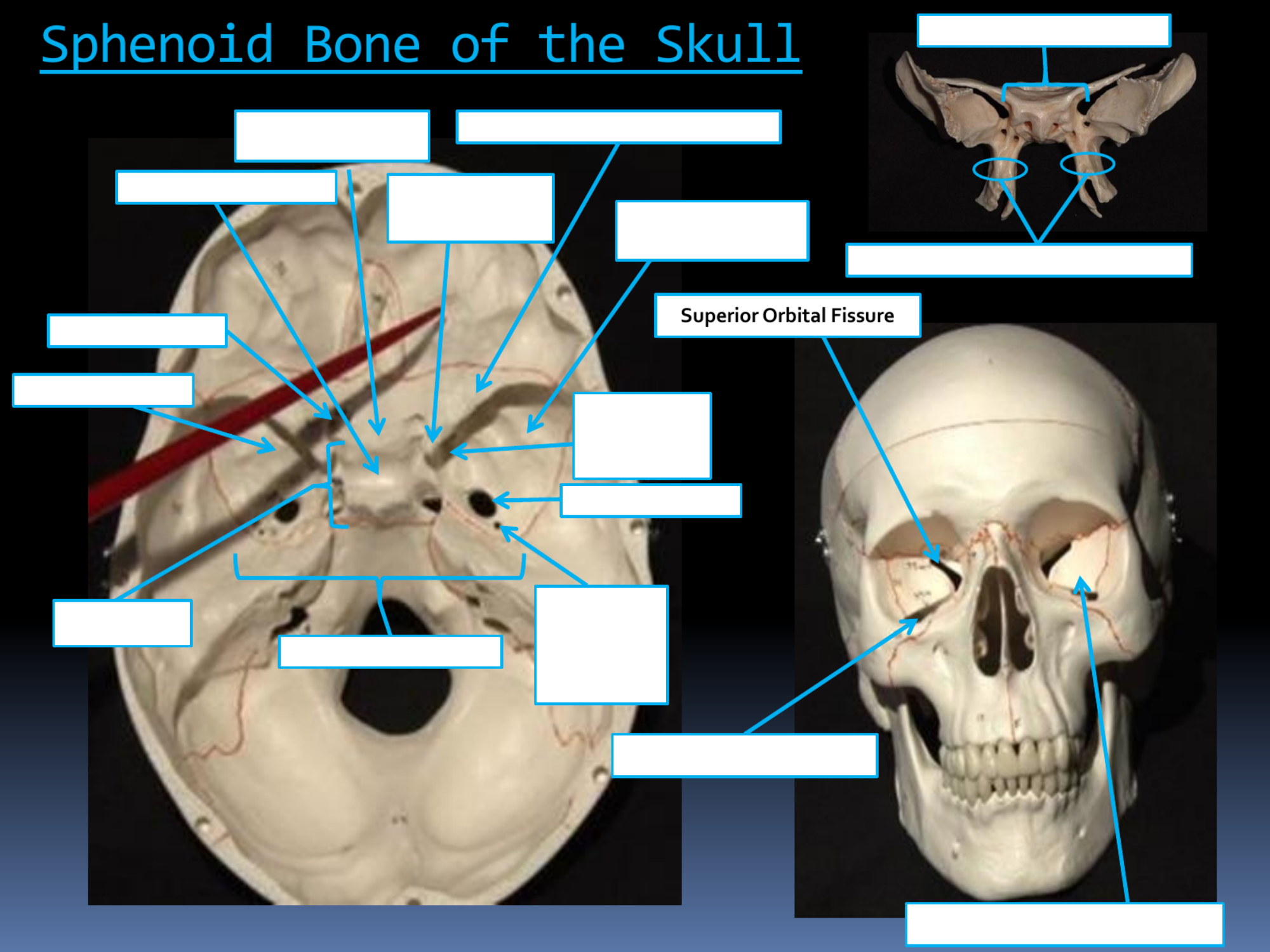 <p>Superior Orbital Fissure</p>