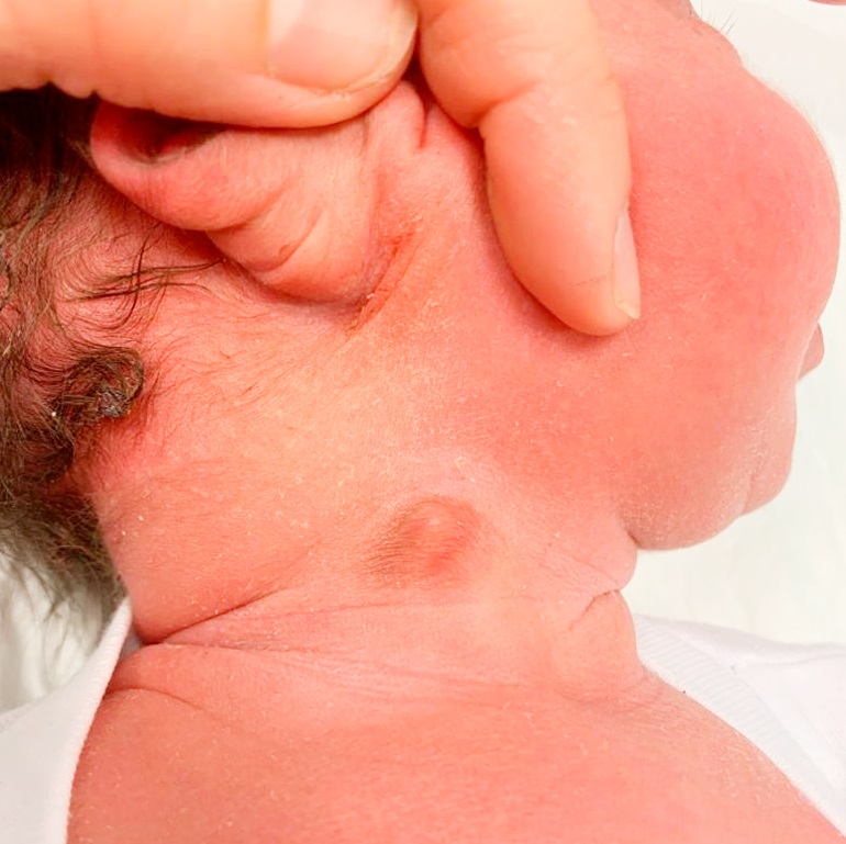 <p>pequeños restos embrionarios cerca oreja o cuello</p>