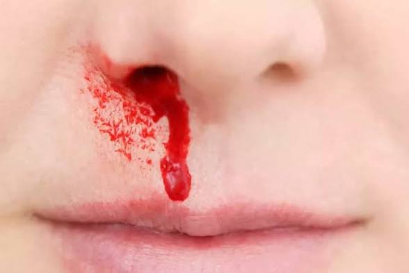 <p>Hemorragia o sangrado que se origina en las fosas nasales, la cavidad nasal o la nasofaringe.</p>