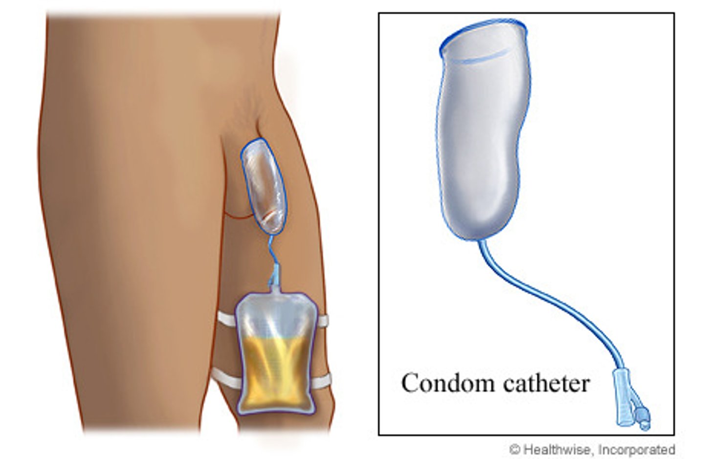 <p>tubing connected to a condom to drain urine; male patients</p>