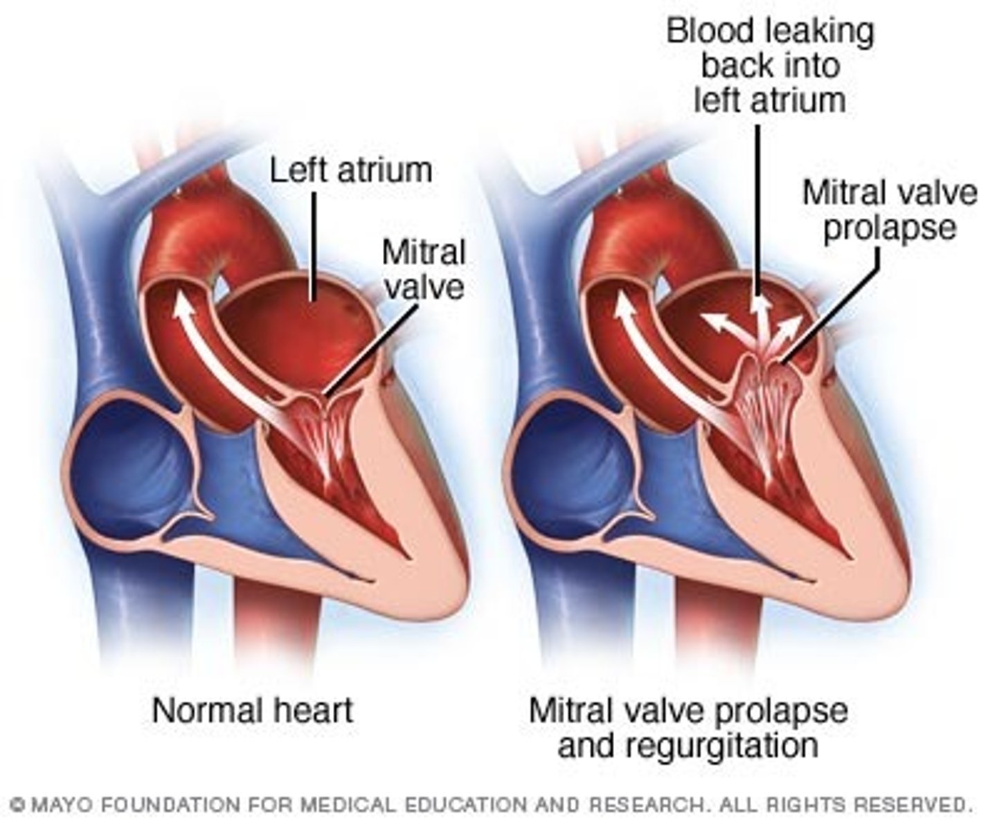 <p>Valve cusps bulge backward into the atrium during contraction, causing backflow.</p>