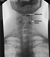 <p>above the epiglottis</p>
