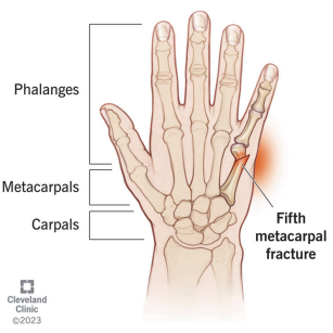 <p>Fracture of the neck of the 5th metacarpal</p><p>● Cause:</p><p>○ Striking an object with a closed fist (common in boxers)</p><p>● Symptoms:</p><p>○ Pain</p><p>○ Swelling</p><p>○ Depression of the knuckle</p>
