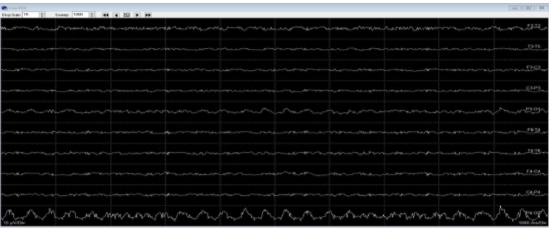 <p>What is this EEG known as? </p>