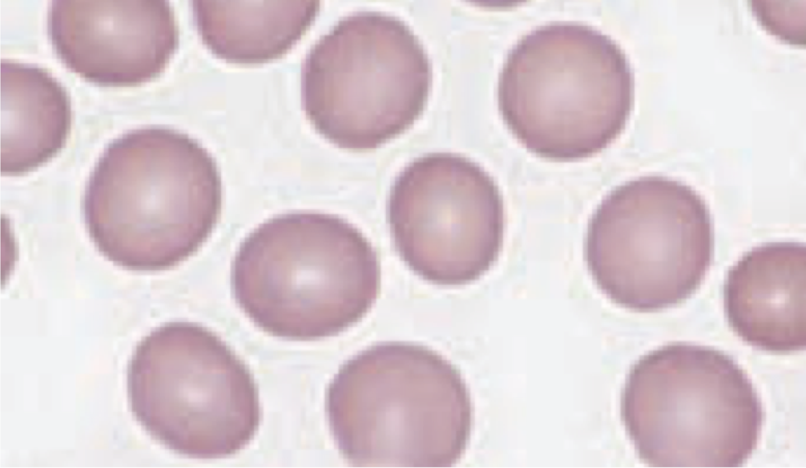 <p>6th stage of erythrocyte formation</p><ul><li><p><strong>diameter: </strong>7-8 micrometers</p></li><li><p><strong>volume:</strong> 80-100 fL</p></li><li><p>bioconcave disc</p></li><li><p>stains <strong>pink to orange</strong> bc of Hb (acidophilic)</p></li><li><p>do NOT have cellular organelles and enzymes to synthesized new lipids/proteins</p><ul><li><p>can’t be repaired</p></li><li><p>can’t synthesize Hb</p></li></ul></li><li><p>carries O2 from lungs and CO2 back</p></li><li><p>flexible to allow for passage throughout the body</p></li></ul><p></p>