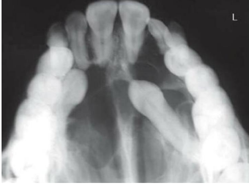 <p>A swelling of palate for 3 years duration showing progressive enlargement. Provide DD. Justify your DD</p>