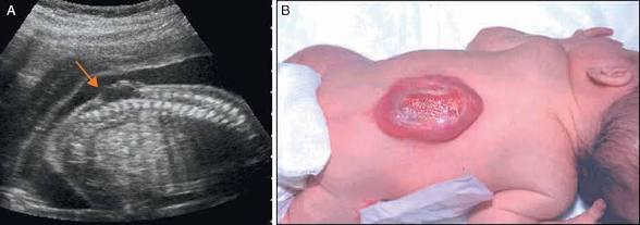 <p>Saco que sobresale de la espalda con tejido neural, meninges y líquido cefalorraquídeo expuestos.</p>