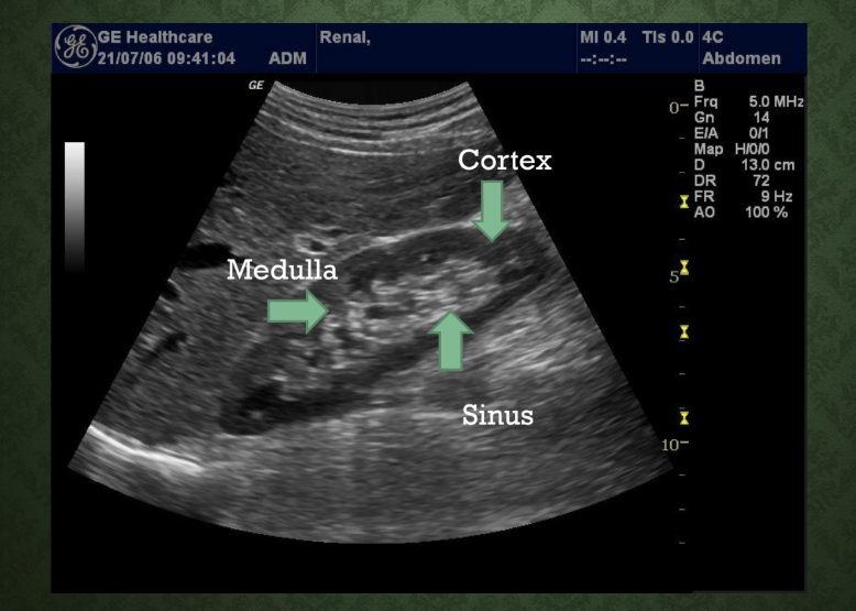 <p>What is the medulla?<br>→ Middle zone of the kidney</p><p>How many renal pyramids are normally in the medulla?<br>→ 8–18 pyramids</p><p>Is the medulla hypoechoic or hyperechoic?<br>→ Hypoechoic</p>