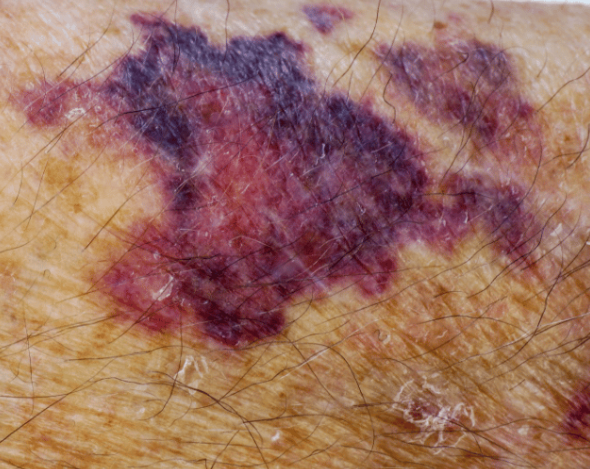 <p>Purpuric (Pur-pure-ick)</p>