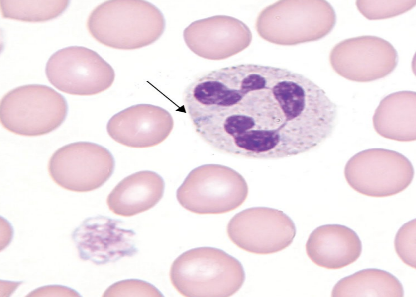 <p>what are the characteristics of may-hegglin?</p>