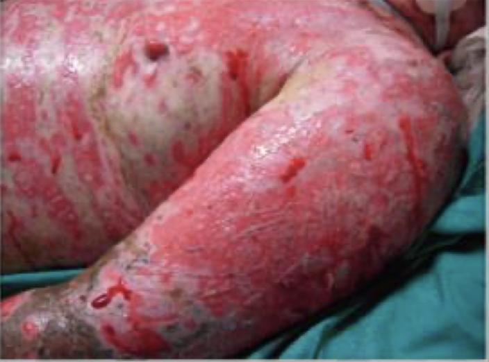 <p>skin drug reaction </p><p>skin detachment of more than 30% of the body surface </p>
