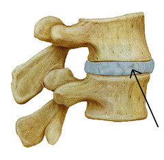 <p>joint connection between vertebrae </p><p>made of two components </p><p>Annulus fibrosis and Nucleus pulposus</p>