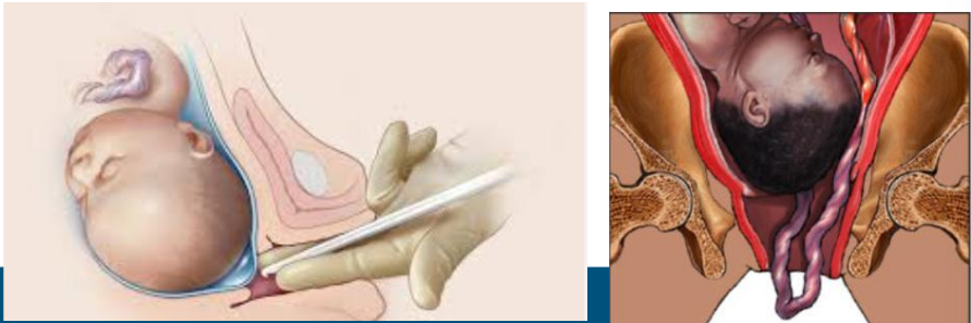 <p><span style="line-height: 20px;"><span>artificial rupturing membranes with a knife or som during labor if they don’t rupture spontaneously&nbsp;</span></span></p><ul><li><p class="Paragraph SCXW153677160 BCX2" style="text-align: left;"><span style="line-height: 20px;"><span>Momentary risk for cord prolapse&nbsp;</span></span></p></li></ul><ul><li><p class="Paragraph SCXW153677160 BCX2" style="text-align: left;"><span style="line-height: 20px;"><span>Only perform if fetal head is well applied to cervix. Always measure FHR immediately after rupture&nbsp;</span></span></p></li></ul><p></p>