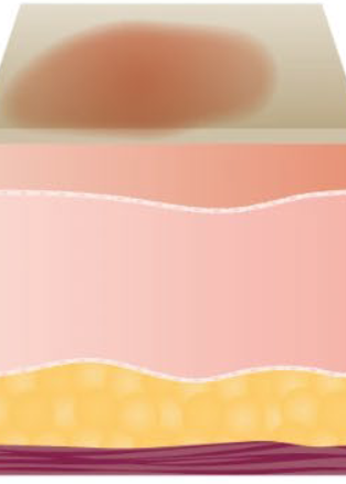 <p>Superficial thickness / first degree burn?</p>