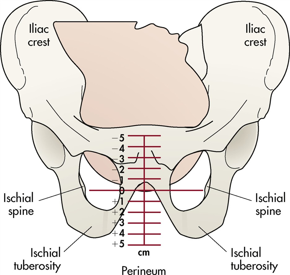 <ul><li><p>Station is the relationship of the presenting fetal part to an imaginary line drawn between the maternal ischial spines and is a measure of the degree of descent of the presenting part of the fetus through the birth canal. The placement of the presenting part is measured in centimeters above or below the ischial spines. For example, when the lowermost portion of the presenting part is 1 cm above the spines, it is noted as being minus (−) 1. At the level of the spines, the station is referred to as 0 (zero). When the presenting part is 1 cm below the spines, the station is said to be plus (+) 1. Birth is imminent when the presenting part is at +4 to +5 cm. The station of the presenting part should be determined when labor begins so that the rate of descent of the fetus during labor can be assessed accurately.</p></li><li><p><strong>Definition:</strong> Relationship of the presenting fetal part to the maternal <strong>ischial spines</strong></p></li><li><p><strong>Measurement scale:</strong> Recorded in centimeters with plus/minus signs</p><ul><li><p><strong>Above spines:</strong> Negative numbers (e.g., -1, -2, -3)</p></li><li><p><strong>At the spines:</strong> 0 (zero station)</p></li><li><p><strong>Below spines:</strong> Positive numbers (e.g., +1, +2, +3)</p></li></ul></li><li><p><strong>Birth imminent:</strong> When presenting part reaches +4 to +5 cm</p></li><li><p><strong>Engagement:</strong> Largest transverse diameter passes through pelvic inlet (usually corresponds to station 0)</p></li></ul><p></p>