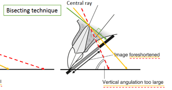 <p>What vertical angulation error results in vertical angle being too large (over-angulation)</p>