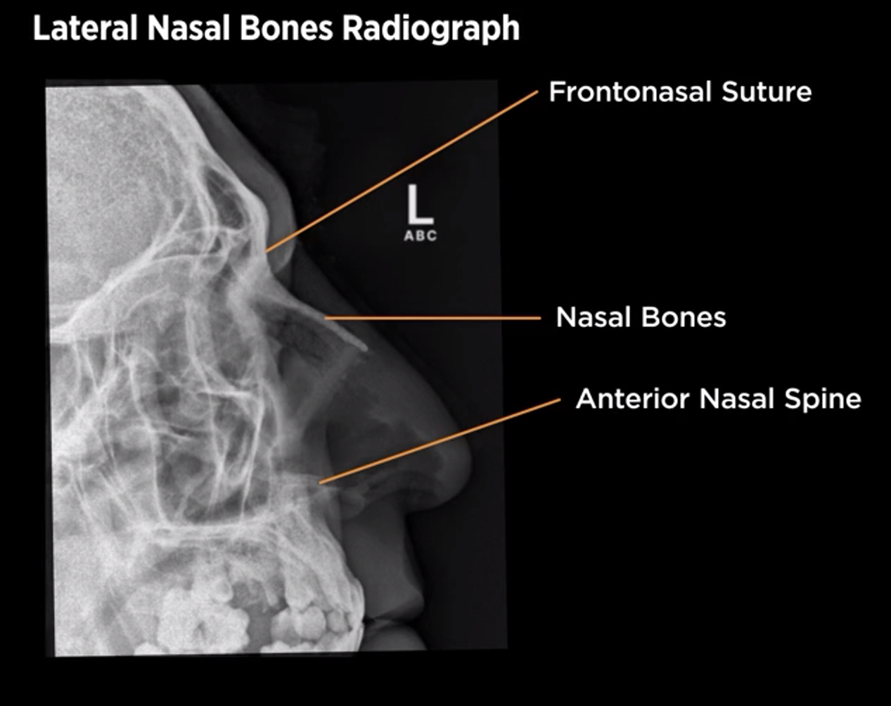 <p>Lateral nasal bones</p>