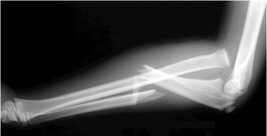 <ul><li><p>Ulnar fracture and radial head dislocated </p></li></ul><p></p>