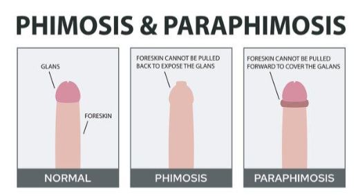 <p>Foreskin cannot be pulled back to expose the glans VS foreskin cannot be pulled forward to cover the glans</p>