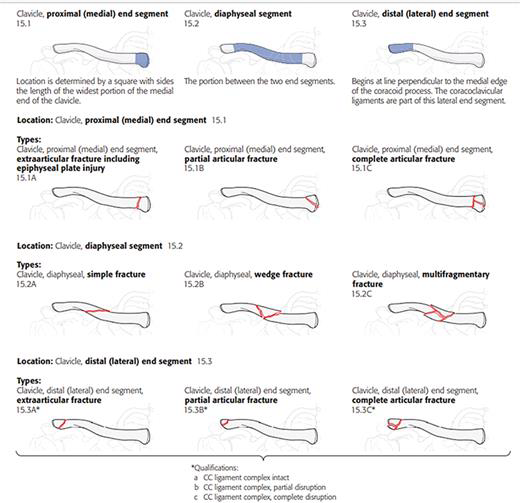 <p>OTA/AO classification scheme of clavicle fractures.</p>