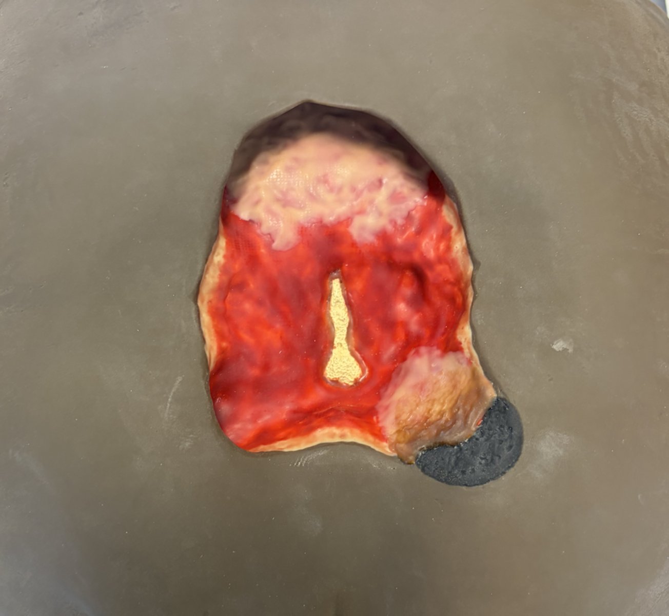 <p>how would you care for this wound?</p>