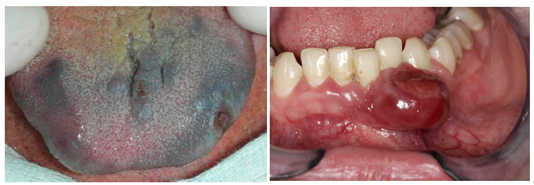 <ul><li><p>normal mucosa-like color, white (keratotic), red, black-brown, bluish-grey…</p></li><li><p>homogenous (even throughout) or variegated (uneven) color are one of the features distinguishing a nevus from melanoma </p></li></ul><p></p>