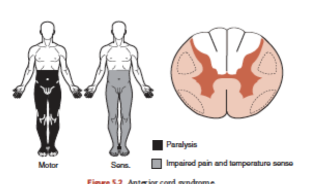 <p>Damage toward front of spinal cord via flexion/dislocation/protrusion</p><p>Loss/impairment ability to sense pain, temeprature and touch below level of injury</p><p>Motor impairment</p>