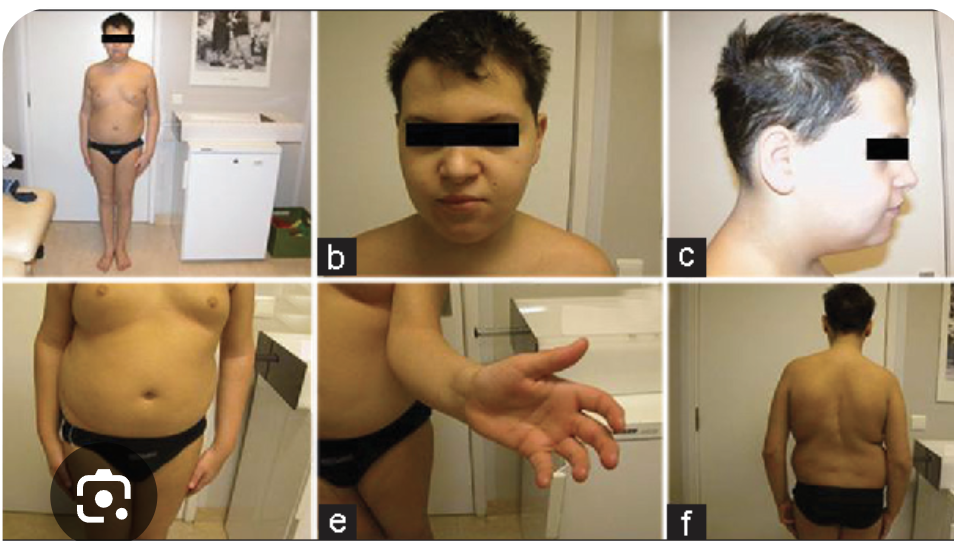 <p>Occurs in Males (XYY)</p><ul><li><p>Taller than average</p></li><li><p>Delayed learning, speech/language, and motor development & Behavioral issues</p></li><li><p>Hypotonia, Hand tremors</p></li><li><p>Asthma, Seizures, Scoliosis</p></li><li><p>Larger teeth</p></li></ul><p></p>