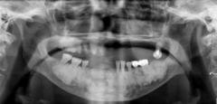 <p>Is this lesion localized or generalized?</p>