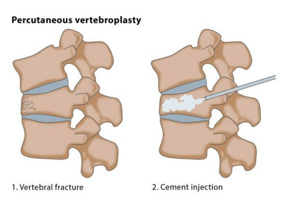 <p>Bone cement injection (purpose is to try and stabilize the vertebral body; e.g., comminuted fx)</p>