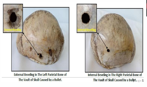 <p></p><div data-type="horizontalRule"><hr></div><p>Questions</p><ol><li><p>What is the specimen being examined?</p></li><li><p>What are the specific anatomical locations and measurements for both injuries?</p></li><li><p>How do the outer and inner tables differ structurally in the right parietal injury?</p></li><li><p>How do the outer and inner tables differ structurally in the left parietal injury?</p></li><li><p>What forensic terms describe the skull bone changes seen in the first and second injuries respectively?</p></li><li><p>What are the causative instrument and the specific trajectory of the missile?</p></li><li><p>How is the time of death estimated?</p></li><li><p>What are the possible causes of death?</p></li><li><p>What is the final diagnosis?</p></li></ol><div data-type="horizontalRule"><hr></div><p></p>