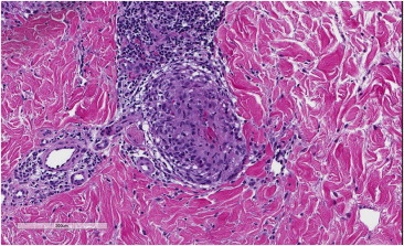 <p>What pattern of myositis is characterized by the formation of granuloma in response to foreign bodies, parasite encystment, fungal infections, or bacterial pathogens?</p>