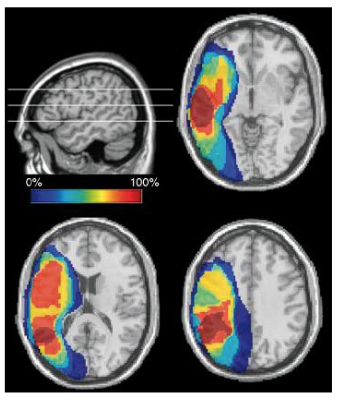 <p><span> Impaired ability to produce, understand, &amp; comprehend language<br> Someone with global aphasia would experience difficulty:<br> Speaking or repeating words/phrases<br> Understanding simple words/phrases<br> With spelling &amp; grammar<br> Understanding figurative language<br> Can be caused by a stroke or traumatic brain injury</span></p>