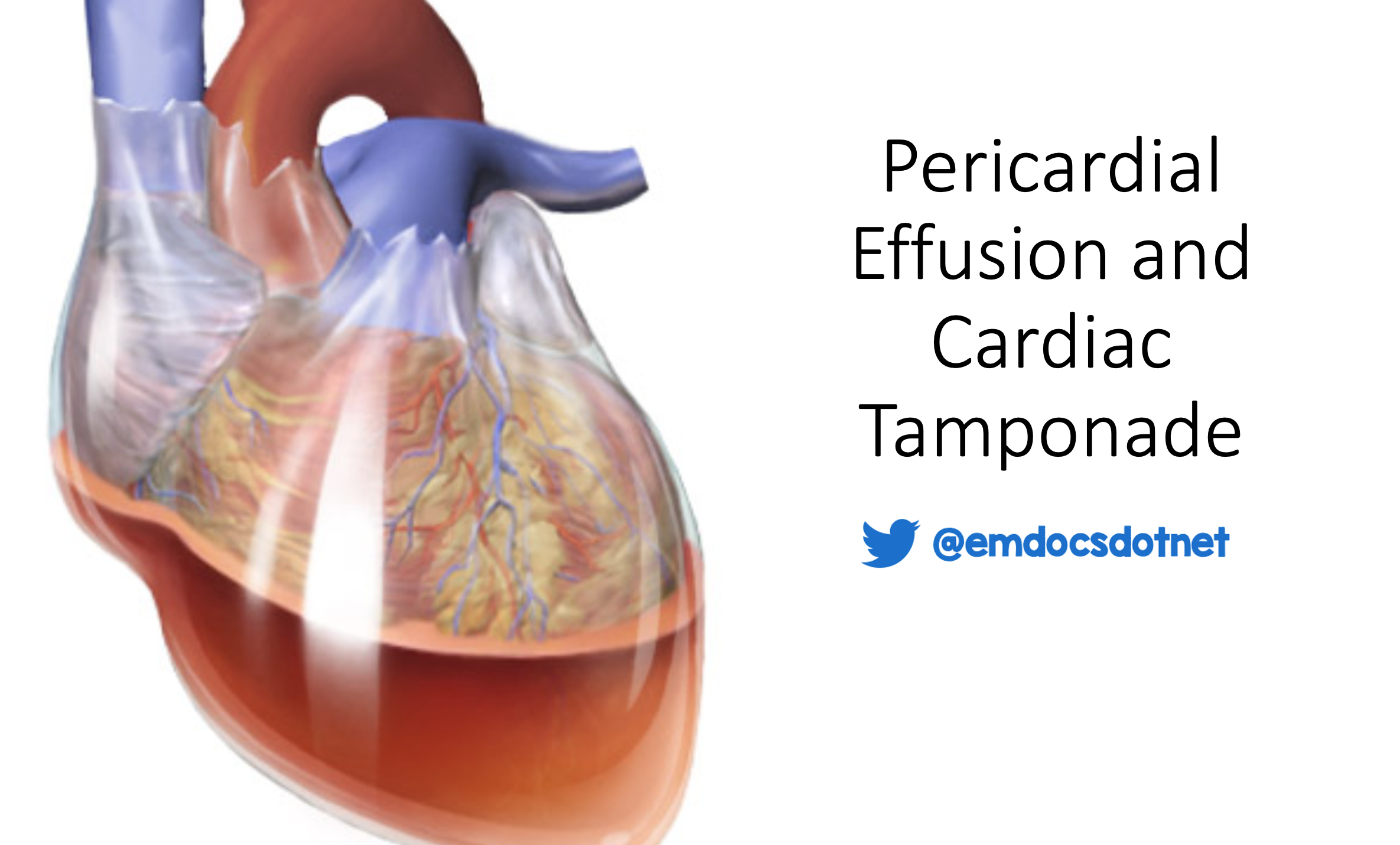 <ol><li><p>Lung </p></li></ol><p>Reasoning:</p><p><strong>lung cancer is the one most classically associated with developing a cardiac tamponade. </strong></p><p><span>The <strong>pericardium</strong> sits directly next to the <strong>left lung</strong> and mediastinum.<br>Certain lung cancers — especially <strong>left‑sided</strong>, <strong>adenocarcinoma</strong>, or <strong>small‑cell</strong> — can:</span></p><p><strong>1. Directly invade the pericardium</strong></p><p><span>Tumor grows into the pericardial sac → fluid accumulates → tamponade.</span></p><p><strong>2. Spread to pericardial lymphatics</strong></p><p><span>Lung cancer commonly metastasizes to mediastinal nodes → blocks lymphatic drainage → pericardial effusion → tamponade.</span></p><p><strong>3. Cause malignant pericardial effusion</strong></p><p><span>Cancer cells seed the pericardium → fluid builds up rapidly.</span></p>
