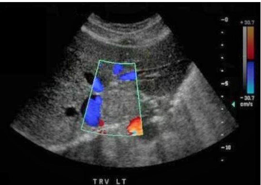 <p>Which of the following statements is true regarding the image displayed? </p><p>a. the liver is demonstrated in the transverse plane at the level of the caudate lobe and has a normal echotexture. There is an enlarged lymph node seen anterior to the aorta and adjacent to the IVC</p><p>b. the liver is demonstrated in the transverse plane at the level of the caudate lobe and has a normal echotexture</p><p>c. there is a mass identified in the lateral left lobe of the liver adjacent to the IVC</p><p>d. there is a mass identified in the caudate lobe of the liver adjacent to the IVC</p>